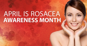 Rosacea Awareness Month - teeth staining?