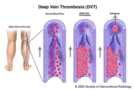How long are people with with deep vein thrombosis (DVT) likely to live?.?