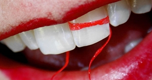 Flossing Day - Do you floss every day?