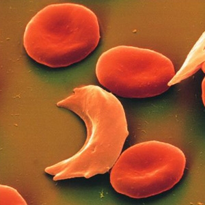 do people with sickle cell disease...?