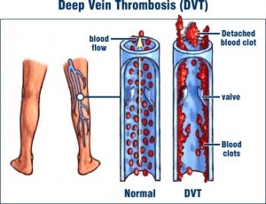 shin splints/deep vein thrombosis (dvt) pain?